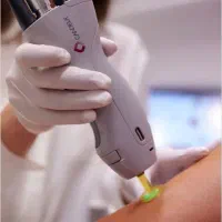 لیزر موهای زائد بدن کندلا