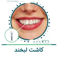 بازسازی فک با اوردنچر