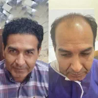 تخفیف ویژه کاشت مو