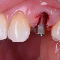 دندانپزشکی تخصصی ایمپلنت دیجیتالی و فوری|خدمات آرایشگری و زیبایی|تبریز, |دیوار