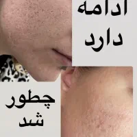 آقایان وخانومای رشتی پوست صاف و روشن حق شماست|خدمات آرایشگری و زیبایی|رشت, گلسار|دیوار