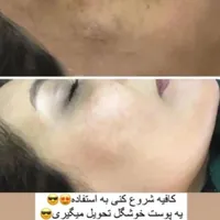 درمان لک ومشکلات پوستی|آرایشی، بهداشتی، درمانی|رشت, کوی جام جم|دیوار