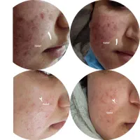 انجام خدمات فیلر ژل بوتاکس