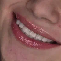 سلامت زیبای با دنتال رویال کامپوزیت/لمینیت