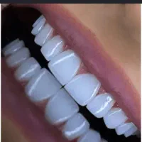 دندان پزشکی/ کامپوزیت / لمینت /باسفته وچک‌