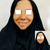 ساخت دندان مصنوعی طرح لمینت با قیمت اقتصادی|خدمات آرایشگری و زیبایی|یزد, |دیوار