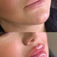 ژل و بوتاکس تخفیف ویژه