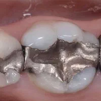 ضایعات آمالگام