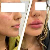 جشنواره تابستانه ژل لب بوتاکس تزریق مزو|خدمات زیبایی و سلامت|تهران, شهرک ولیعصر شمالی|دیوار