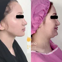 لیپوفیس سوپرکانتور ساکشن غبغب لیپوغبغب کلینیک لارا|خدمات آرایشگری و زیبایی|تهران, صادقیه|دیوار