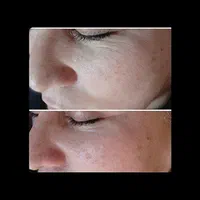 *مدل*فیشال پاکسازی پوست فقط ۲۶۰هزارتومن|خدمات آرایشگری و زیبایی|مشهد, صیاد شیرازی|دیوار