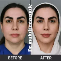 تخفیف ویژه، ساکشن تزریق چربی بلفارو کانتو اپیکانتو|خدمات آرایشگری و زیبایی|مشهد, هفت تیر (حافظ)|دیوار