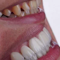 دندانپزشکی.کامپوزیت.لمینت|خدمات زیبایی و سلامت|تهران, سعادتآباد|دیوار
