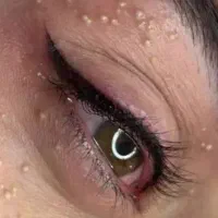 خال و زگیل،میخچه،کک و مک،لیپوم وکلوئید،میلیا و تگ