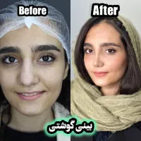 جراحی بینی با شرایط ویژه|خدمات آرایشگری و زیبایی|مرودشت, شهرک مهدیه|دیوار