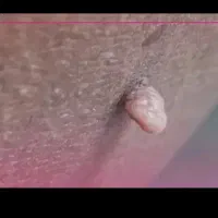 درمان قطعی زیگیل تناسلی با روش گیاهی و تضمینی