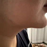 جشنواره ژل لب تزریق واموزش ژل بوتاکس چربی مزوتراپی