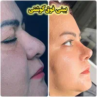 عمل بینی پیکرتراشی پروتزسینه ابدولیپو اقساط بی سود|خدمات آرایشگری و زیبایی|شیراز, معالی‌آباد|دیوار