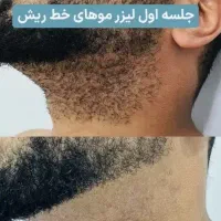قویترین دستگاه لیزرموزائد۲۰۲۶+بوتاکس رایگان/خط ریش