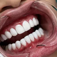 کامپوزیت ۸۰٪تخفیف(فکی۵تومن،اقساط۶ماهه)