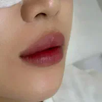 ژل و بوتاکس صورت|خدمات آرایشگری و زیبایی|فولادشهر, مسکن مهر فولادشهر|دیوار