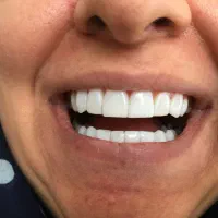 دندانپزشکی دندانسازی پونک سیمون بولیوار کامپوزیت|خدمات زیبایی و سلامت|تهران, شهرک کوهسار|دیوار