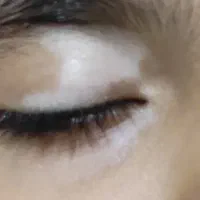 واریس . ویکتوریا .پیسی .لکه پیس