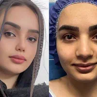 اف عمل بینی