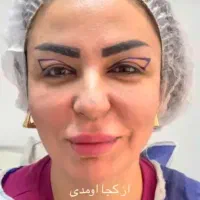 بلفاروپلاستی ۴۵۰۰/غبغب۴۵۰۰/کاشت ابرو|خدمات آرایشگری و زیبایی|ری, دیلمان|دیوار