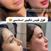 جشنواره ویژه فیلر لب فول فیس زاویه فک،گونه،چونه و.|خدمات آرایشگری و زیبایی|مشهد, شهید فرامرز عباسی|دیوار