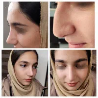 رینوپلاستی