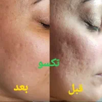 پوست کره ای|خدمات آرایشگری و زیبایی|ارومیه, |دیوار