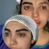 میکروکاشت ابرو باو بدون جراحی/کاشت مو بدون تراشیدن