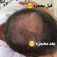 میکرواسکالپ جایگزین و مکمل کاشت مو