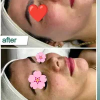 فیشال و پاکسازی درمانی پوست