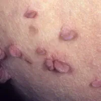 برداشتن منگوله و زگیل های گوشتی در چند روز