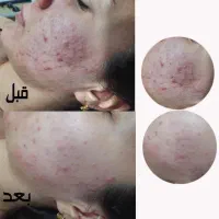 کربوکسی تراپی+فیشال تخصصی ۴۷۵ ظرفیت ۵ نفر|خدمات آرایشگری و زیبایی|بیرجند, |دیوار