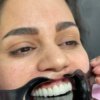 کاشت دندان ایمپلنت کره ایی ۱۱/۵ توسط جراح ایمپلنت