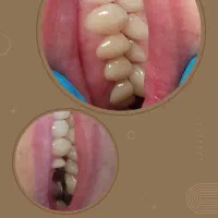 روکش دندان در مطب