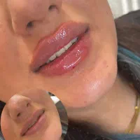پی آرپی و مزوتراپی و تزریق فیلر با بهترین قیمت