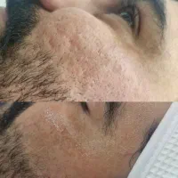 با فیشال تخصصی کلینیک لک و جوش خود را از بین ببر|خدمات آرایشگری و زیبایی|بندرعباس, |دیوار