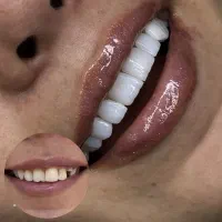 کامپوزیت تخصصی فقط از فکی ۳.۵ اقساطی