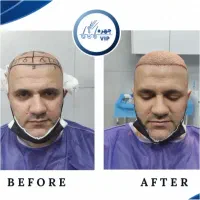 کاشت مو در یکروز|خدمات آرایشگری و زیبایی|تهران, گاندی|دیوار
