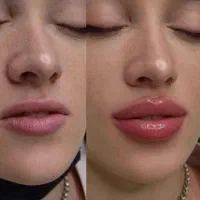 تزریق ژل فیلر بوتاکس تخفیف پاییزی|خدمات آرایشگری و زیبایی|اصفهان, مرداویج|دیوار