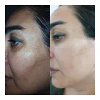 پاکسازی تخصصی صورت توسط پزشک فقط۳۰۰تومن