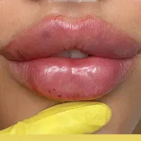 جشنواره تخفیفات ژل،بوتاکس،مزوژل،سلول بنیادی