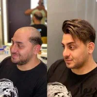 پروتز مو وارداتی ،کاشت hrt