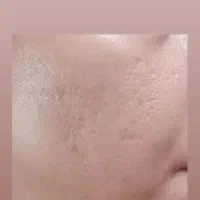 ماسک و کرم چاله چوله و منافذ باز صورت|آرایشی، بهداشتی، درمانی|مشهد, نوید|دیوار