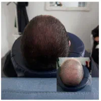 اسکالپ سر(سیار هستم)