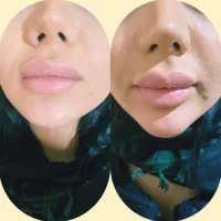 جشنواره ویژه تخفیفی تزریق ژل و بوتاکس و لیزر|خدمات آرایشگری و زیبایی|تهران, نیروی هوایی (پیروزی)|دیوار